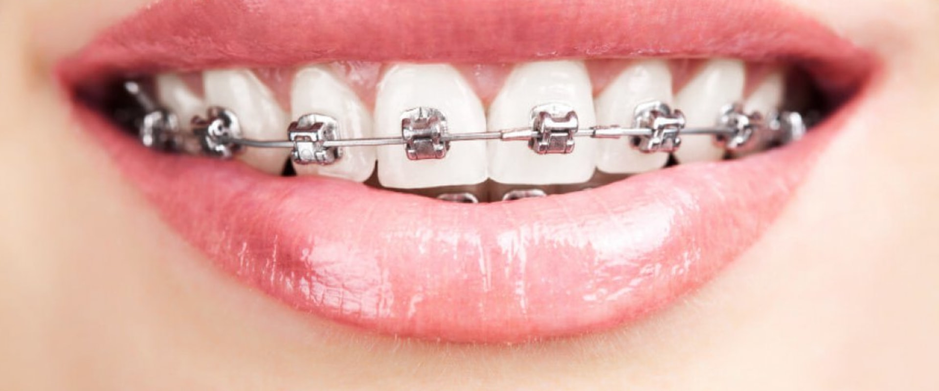 What is the Least Painful Type of Braces?