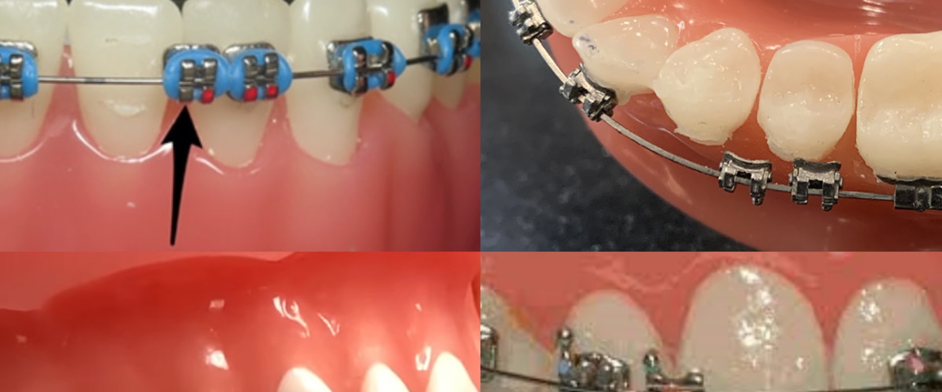 Do Braces Still Work with a Loose Bracket?