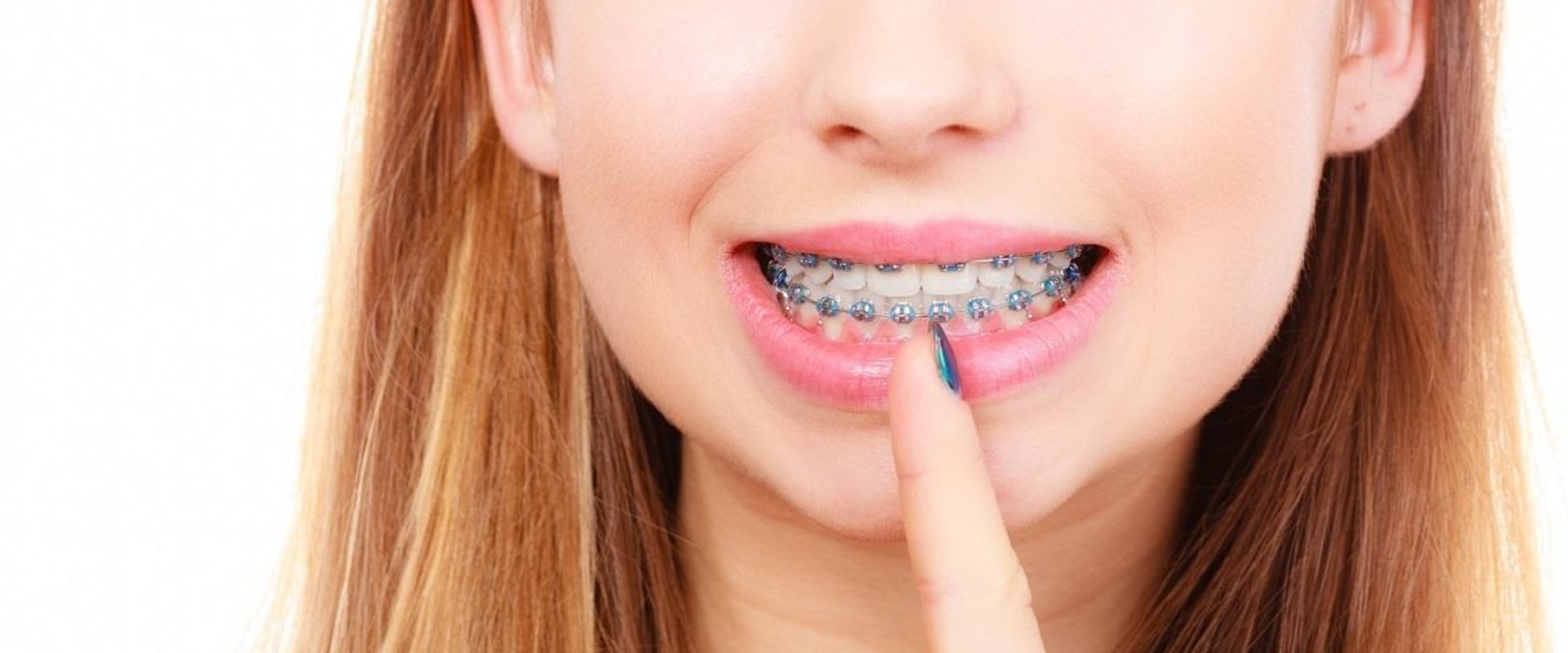 Can I Whiten My Teeth While Wearing Braces