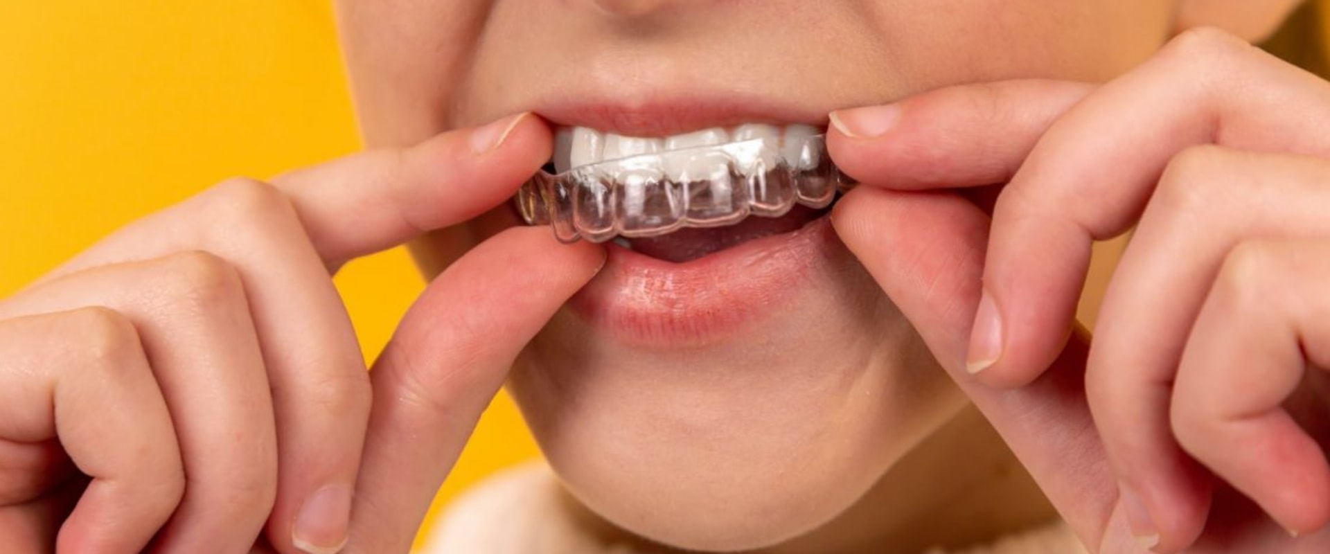 Can I Get Invisalign with Missing Teeth or Gaps in My Teeth?