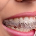 What Foods Should I Avoid When Wearing Braces or Aligners?