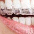 Why Invisalign is the Preferred Orthodontic Treatment for Many Dentists