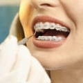 Can Adults Get Orthodontic Treatment?