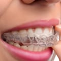 Straighten Your Teeth with Braces or Aligners: What You Need to Know