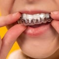 Invisalign vs Braces: Which is Easier to Talk With?