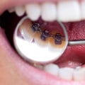 Which Orthodontic Appliance is Better: Lingual or Traditional Braces?