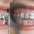 How Long Does Orthodontic Treatment Take? An Expert's Perspective