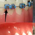 Do Braces Still Work with a Loose Bracket?