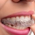 Do Invisalign Braces Take Longer Than Traditional Braces?