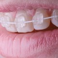 Can Adults Get Braces at Any Age?