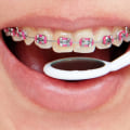 Types of Orthodontic Treatments: What You Need to Know