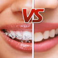 Invisalign vs Braces: Which is the Best Orthodontic Treatment for You?