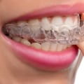 Do I Need to Have Any Teeth Removed for Orthodontic Treatment?