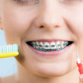 Caring for Your Braces: A Comprehensive Guide