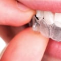 How to Clean Invisalign Retainers and Aligners