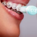 Brushing and Flossing with Braces or Aligners: Expert Tips