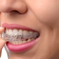 Do I Need to Have Any Teeth Extracted for Invisalign Treatment?