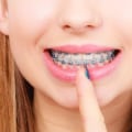 Can I Whiten My Teeth While Wearing Braces?