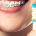 Using a Phone with Braces or Aligners: Expert Tips