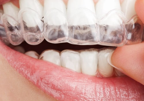 Types of Braces: A Comprehensive Guide