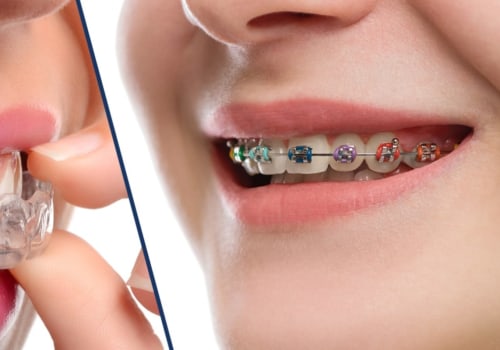 Straighten Your Teeth with Braces or Aligners: What You Need to Know