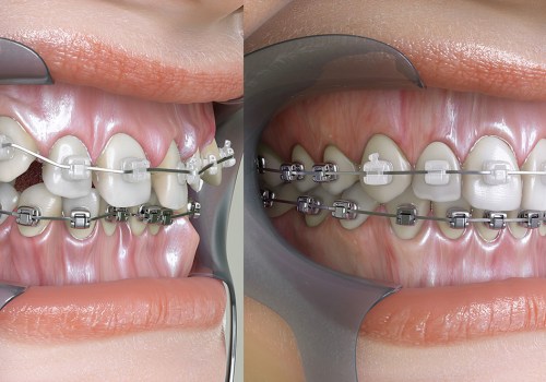 How Long Does Orthodontic Treatment Take? An Expert's Perspective