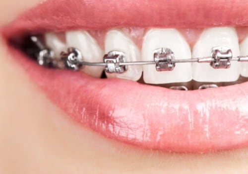 What is the Least Painful Type of Braces?