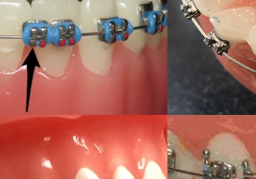 What to Do When a Braces Bracket Breaks