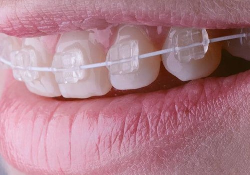 Can Adults Get Braces at Any Age?