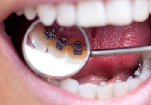 The Pros and Cons of Traditional Braces vs Lingual Braces
