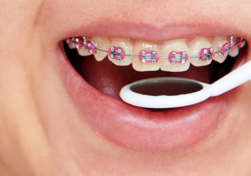 Types of Orthodontic Treatments: What You Need to Know