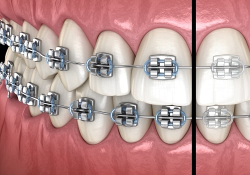 Metal or Ceramic Braces: Which is Better for Orthodontic Treatment?