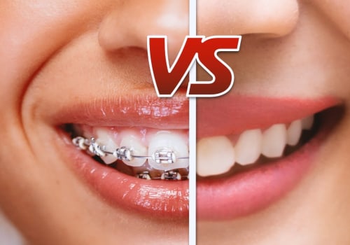 Invisalign vs Braces: Which is the Best Orthodontic Treatment for You?