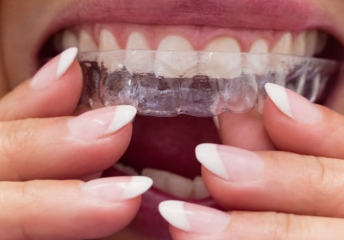 Why Invisalign is the Best Choice for Orthodontic Treatment