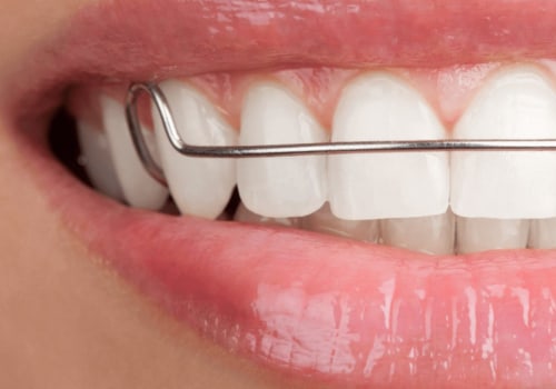 How Often Should I Wear My Retainer After Invisalign Treatment?