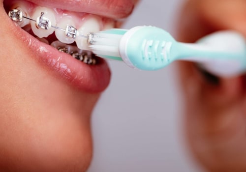 Brushing and Flossing with Braces or Aligners: Expert Tips