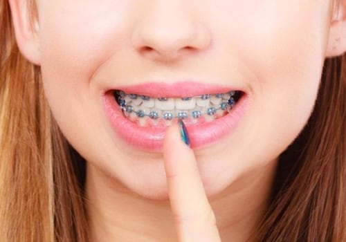Can I Whiten My Teeth While Wearing Braces?