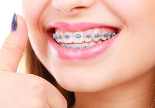 The Benefits of Orthodontics and How to Choose the Right Orthodontic Appliances